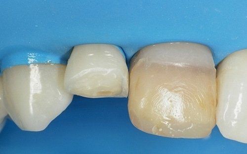 Primo piano di diversi denti con uno sfondo blu dentale, che mostra un dente scolorito e uno spazio vuoto lasciato da un dente mancante.