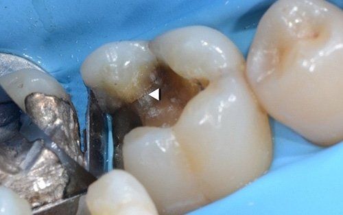 Primo piano di un molare con una carie scura esaminato con uno strumento odontoiatrico.