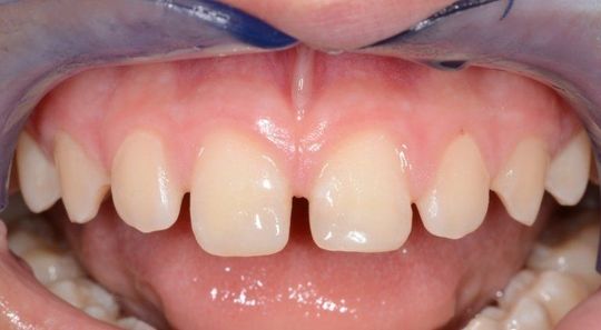 Primo piano dei denti incisivi superiori con uno spazio tra i due incisivi e un divaricatore labiale blu.