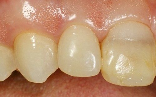 Primo piano di denti e gengive con un evidente spazio tra gli incisivi centrali.