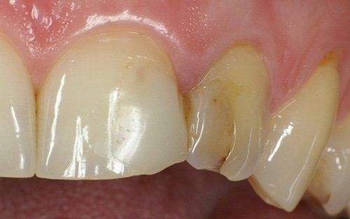 Primo piano di denti frontali incrinati e scheggiati con danni visibili allo smalto.