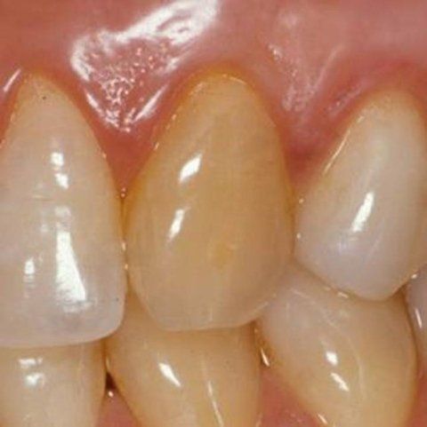 Primo piano di denti frontali storti con gengive ingiallite e rosa.