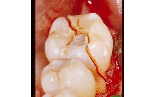 Primo piano di un molare fratturato con cavità visibile e tessuto gengivale arrossato.