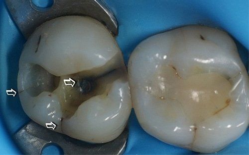 Primo piano di due molari, uno dei quali presenta una cavità scura evidenziata dalle frecce.