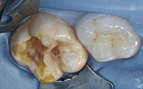 Primo piano di due molari, uno con una grande carie e una demineralizzazione marrone, su una superficie dentale blu.