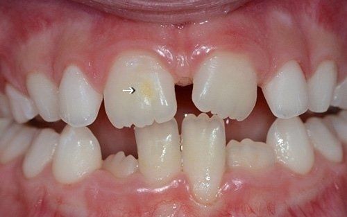 Primo piano dei denti di un bambino, che mostrano evidenti spazi vuoti e disallineamenti.