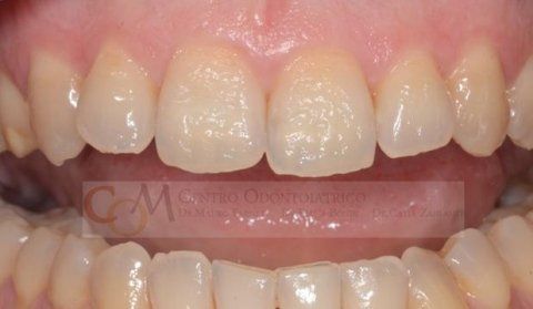 Primo piano dei denti superiori e inferiori, con uno spazio tra gli incisivi e la lingua visibile in bocca.