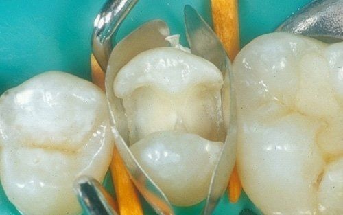 Primo piano di tre corone dentali o otturazioni sui molari in una bocca
