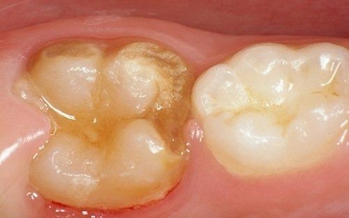 Primo piano di due molari, uno con una carie marrone e uno intatto, in una bocca
