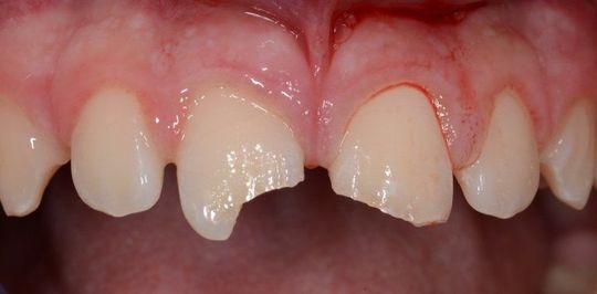 Primo piano dei denti frontali superiori con gengive rosse e infiammate e uno spazio vuoto lasciato da un dente mancante.