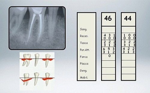 Radiografia dentale e grafico parodontale che mostrano le misurazioni dei denti e i livelli gengivali per i denti 46 e 44.