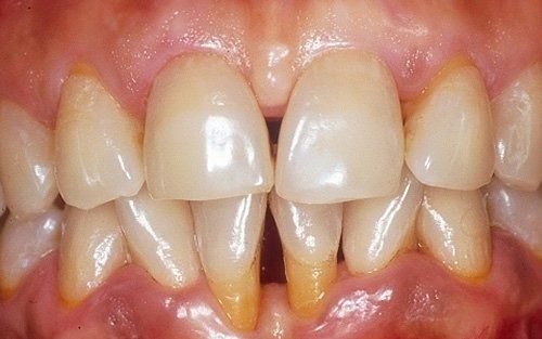 Primo piano di denti con accumulo di tartaro giallastro e gengive infiammate.