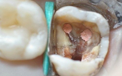 Primo piano di un molare con una grande carie e due otturazioni rosa, separate da uno strumento odontoiatrico color verde acqua.