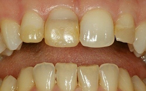 Primo piano di denti con spazi e scolorimenti evidenti, in particolare i denti frontali superiori e inferiori.
