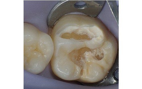 Primo piano di un dente molare con carie visibile e uno strumento odontoiatrico metallico nelle vicinanze.