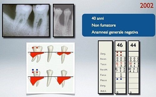 Preparato medico con radiografie dentali, diagrammi delle radici e statistiche etichettate 