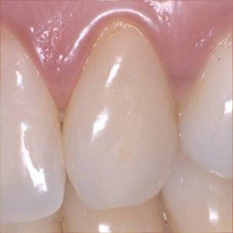 Primo piano di denti bianchi e sani e gengive rosa