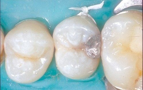 Primo piano di tre molari isolati con una diga dentale turchese e un filo interdentale bianco.