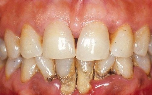 Primo piano di denti gravemente cariati con accumuli di placca giallo-marrone e gengive rosse e gonfie.