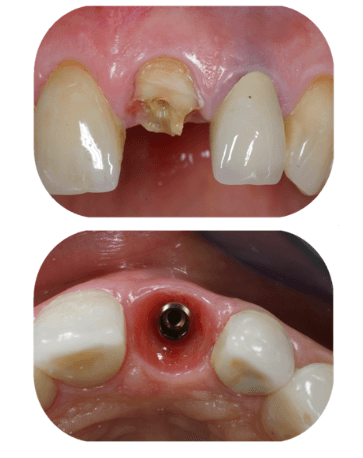 Due immagini ravvicinate del sito di impianto di un dente frontale: una con il dente danneggiato e una con il perno dell'impianto esposto.