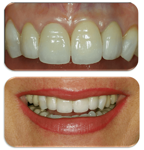 Primo piano di un trattamento dentale prima e dopo: denti bianchi e allineati sopra, labbra sorridenti con l'apparecchio visibile sotto