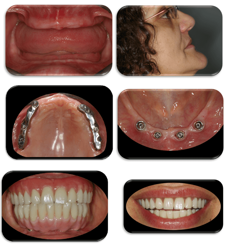 Montaggio del trattamento con impianti dentali: gengive, profilo laterale, impianti nell'arcata superiore e sorrisi prima e dopo.
