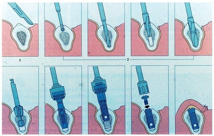 Schema medico passo passo che mostra uno strumento per rimuovere un oggetto blu da una piccola cavità.