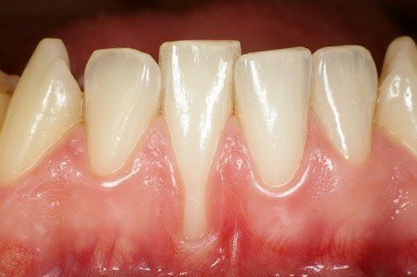 Primo piano dei denti frontali inferiori e delle gengive rosa con recessione gengivale visibile.