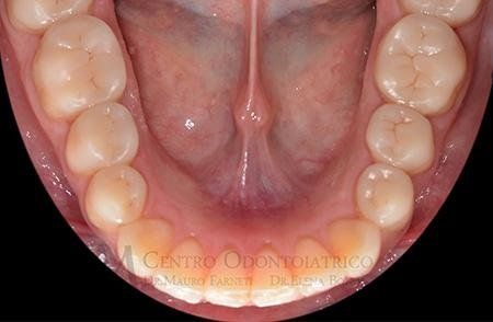 Placement of Occlusal Inlays for complete restoration of worn surfaces.