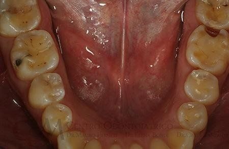 Erosione della superficie smalto-dentinale