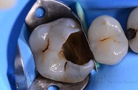 E' già stato perso tessuto dentario, dunque non è il caso di preparare anche il dente per accogliere una corona. Più conservativo posizionare l'intarsio solo nella porzione di dente mancante