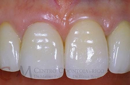 The definitive crown applied. Note the excellent integration with the adjacent teeth. 