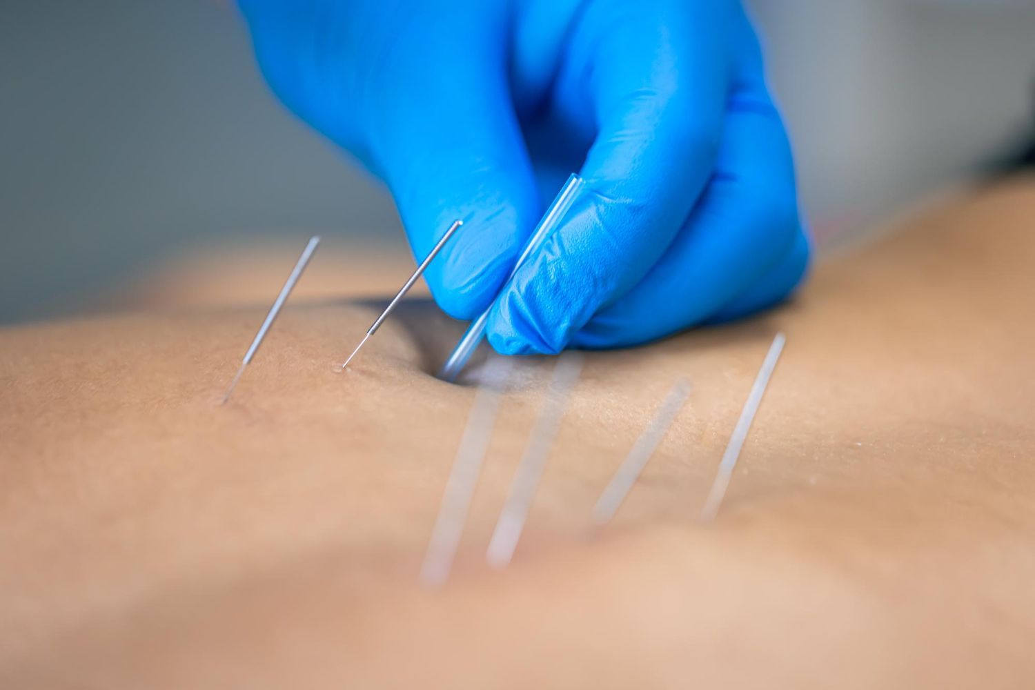 A practitioner wearing blue medical gloves inserts a thin acupuncture needle into a patient's skin.