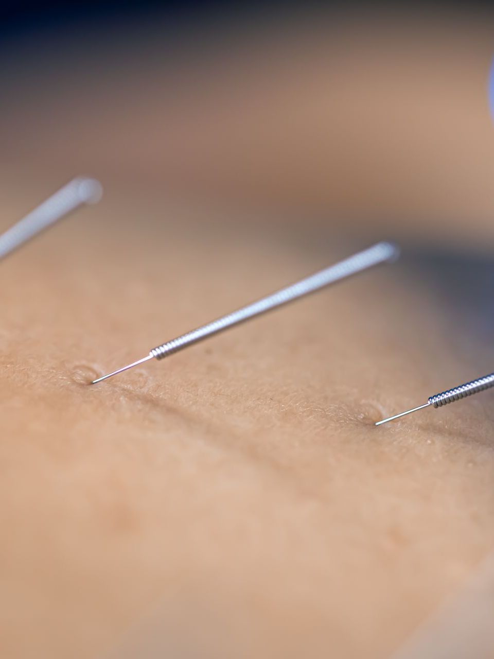 a close up of acupuncture needles on a person 's back