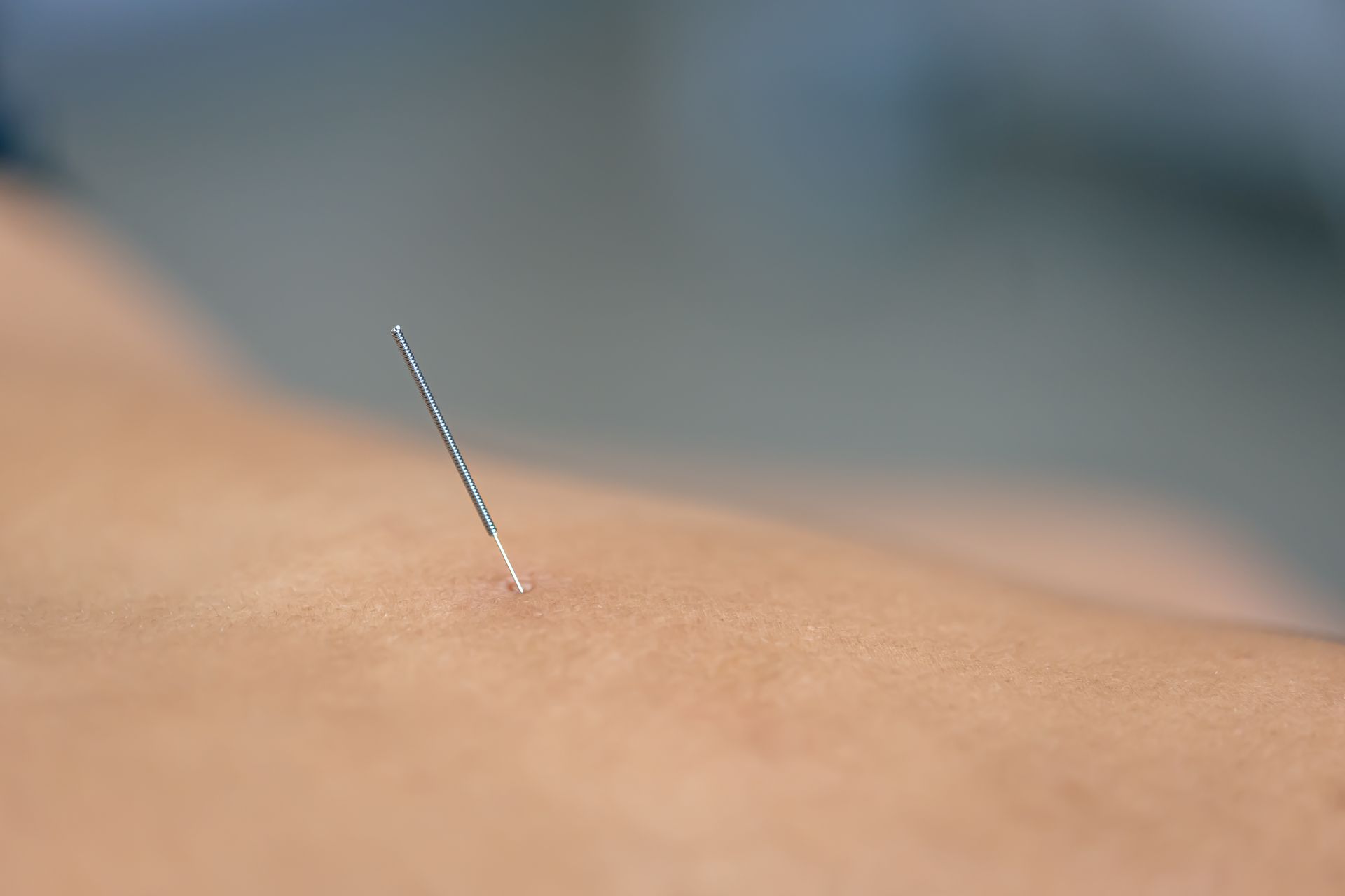 a close up of an acupuncture needle in a person 's skin