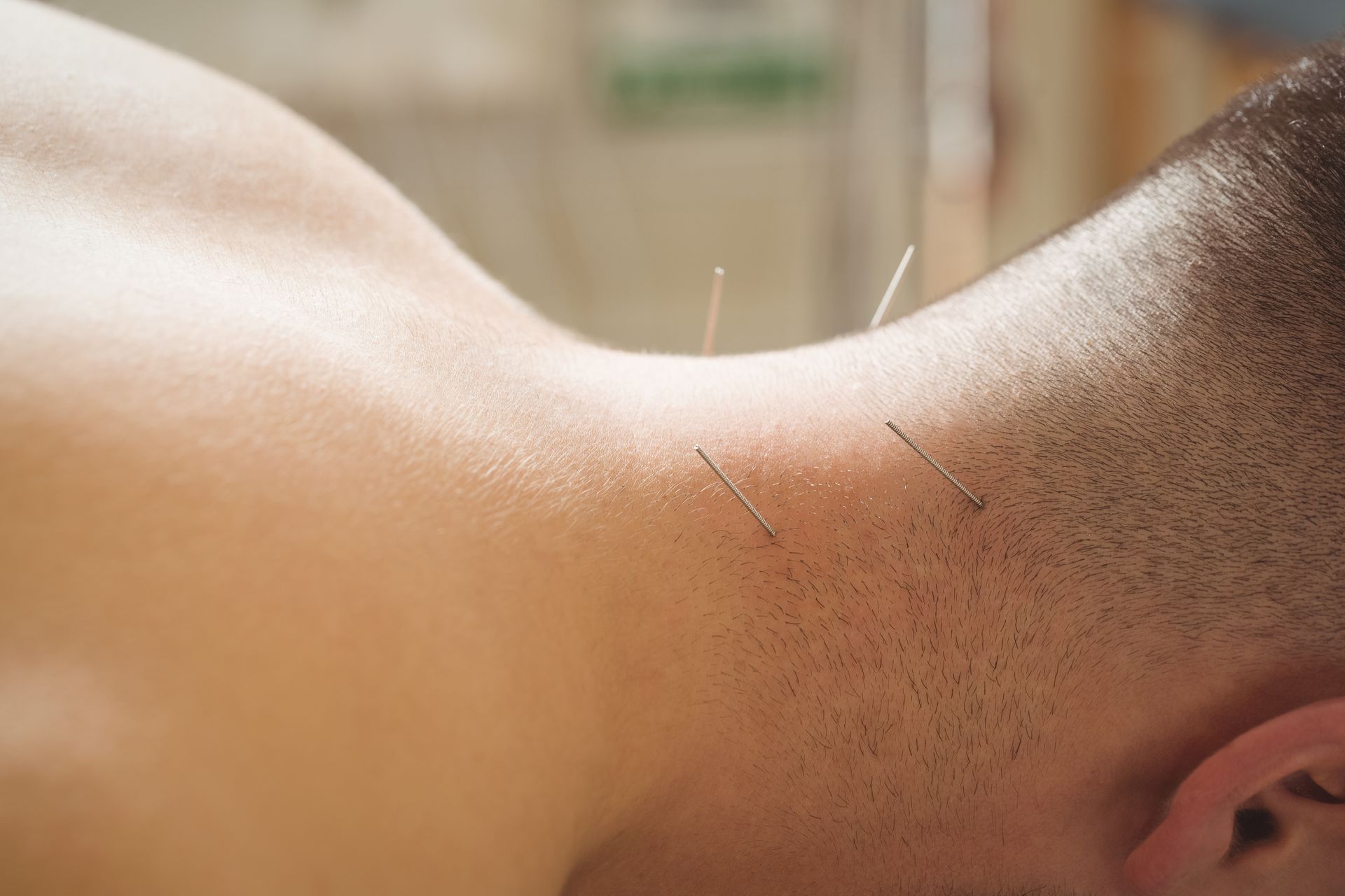 a man has acupuncture needles in his neck