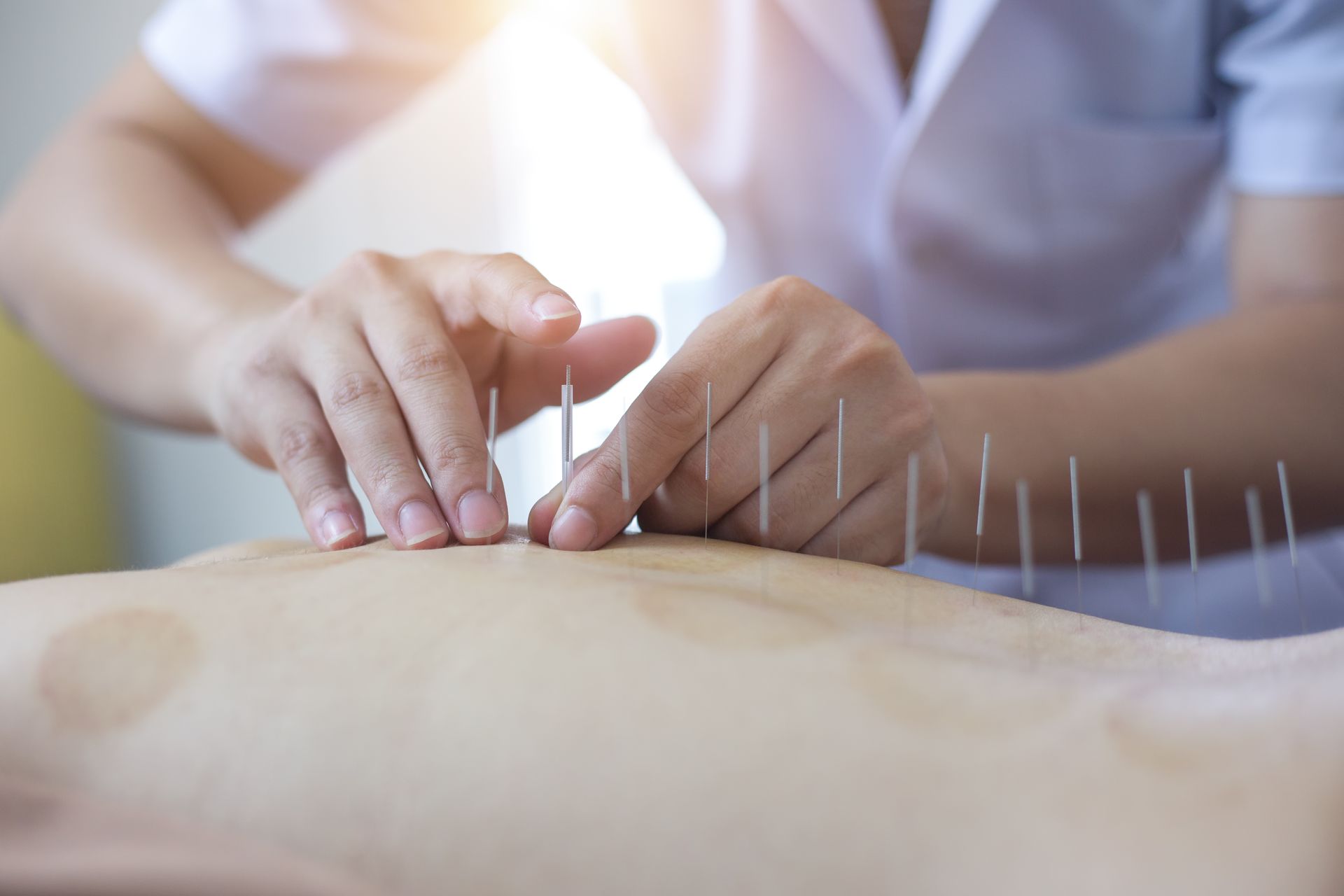 A person is getting acupuncture on their back by a doctor.