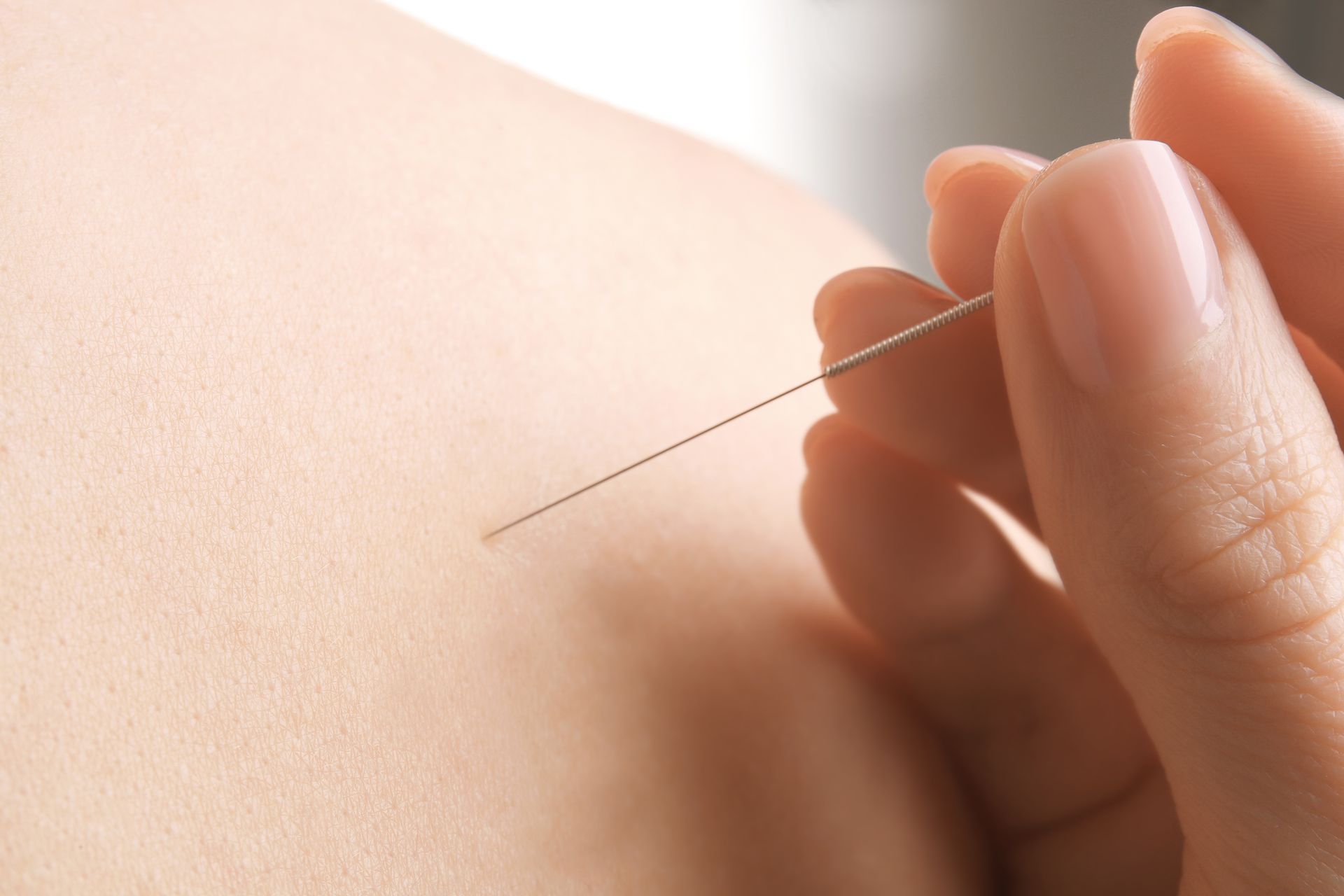 a person receiving dry needling treatment