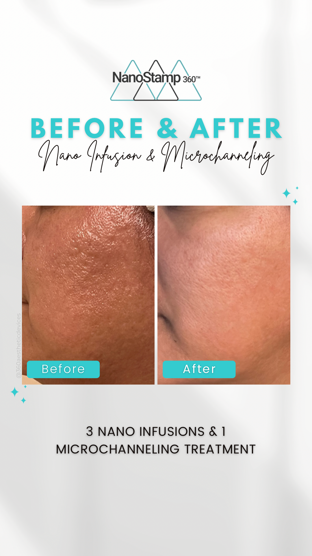 NanoStamp Before and After — Newtown, PA — Bally Beauty