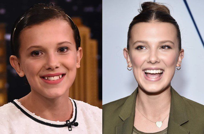 Millie Bobby Brown before and after Porcelain Veneers