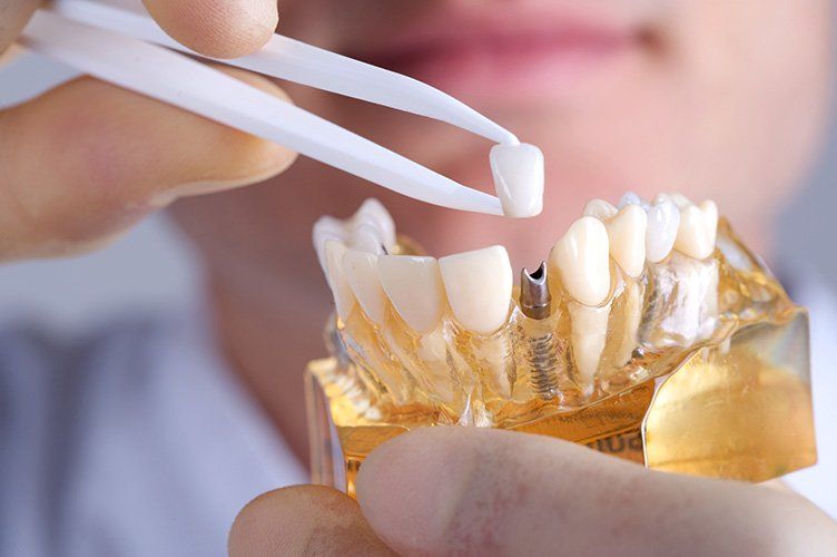 Dental Implants  - Sterling Dental Center Services