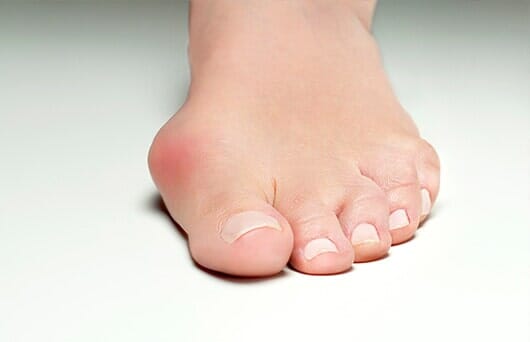 Bunion in Woman foot  — Podiatry Clinic in Eugene, OR