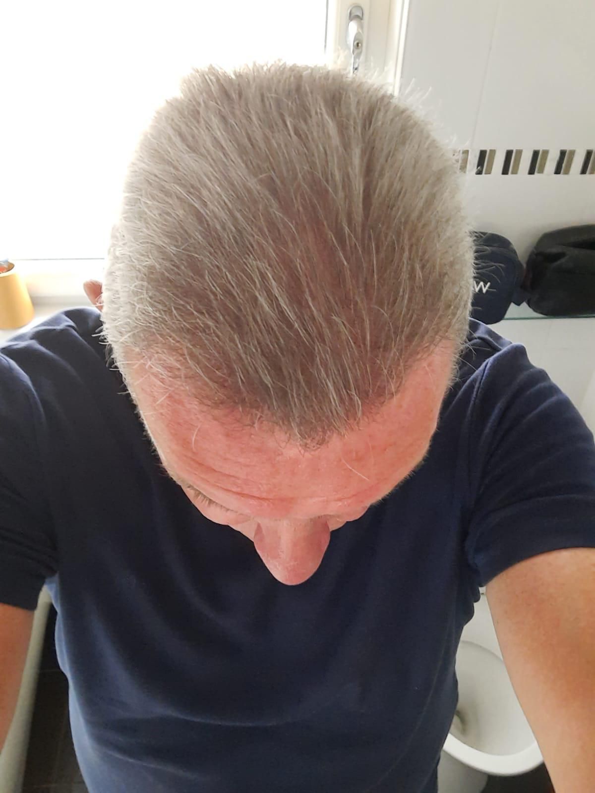 A picture of a male after undergoing a crown hair transplant