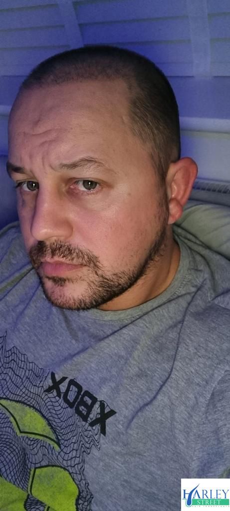 A picture of a hair transplant carried out by Harley Street hair transplants Manchester