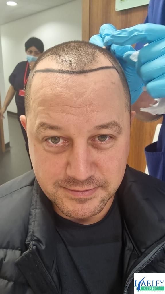 A picture of a hair transplant patient marked up prior to surgery