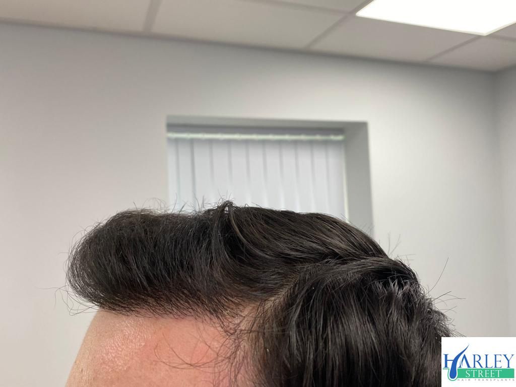 A picture of a male patient after undergoing fue at the manchester hair transplant clinic