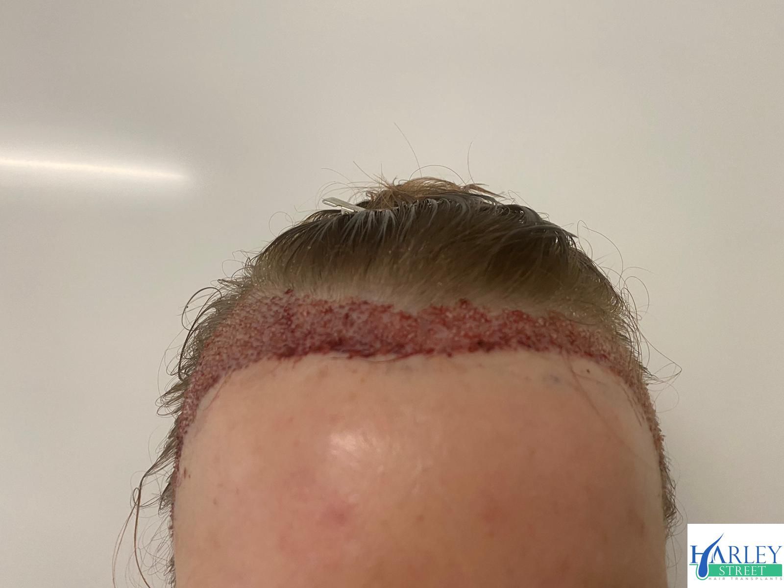 A female undergoing an FUT hair transplant