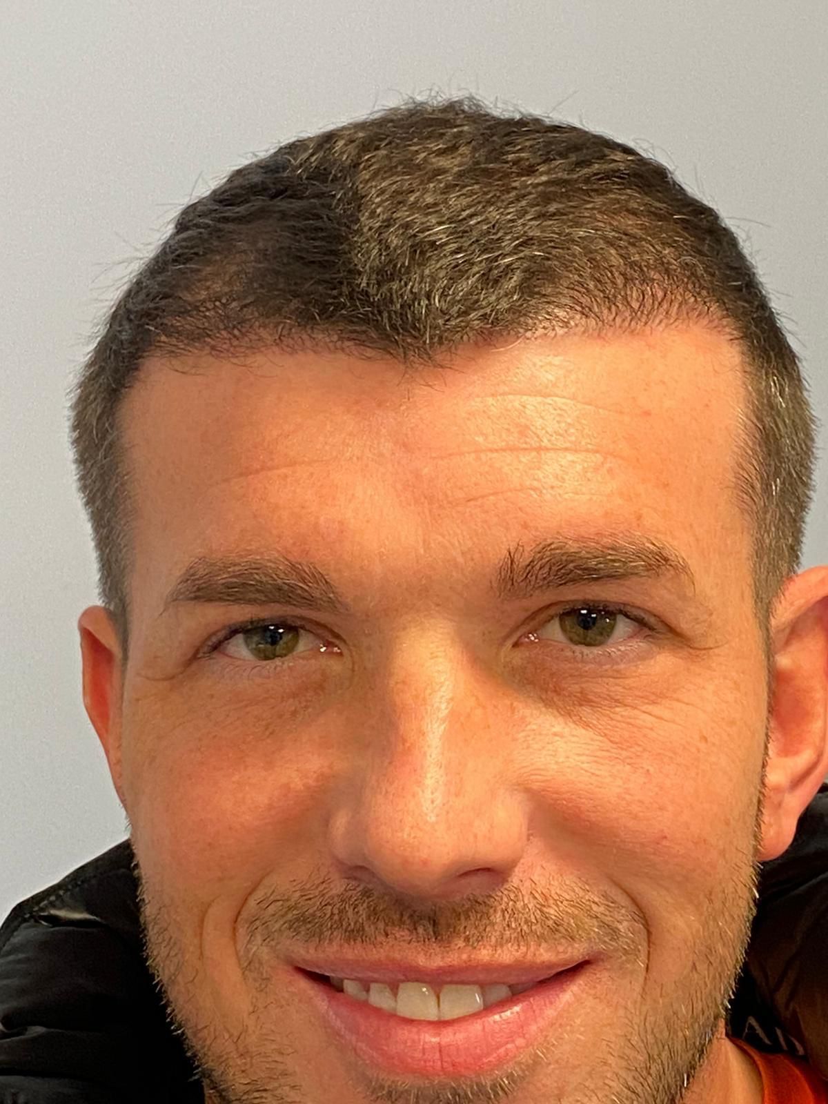 An after photo of a male who has undergone FUE surgery