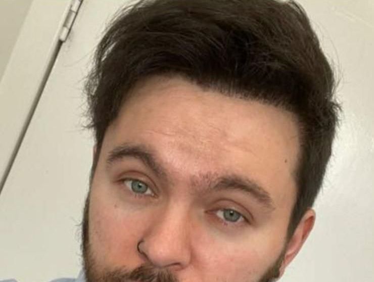 A picture of a male after FUE