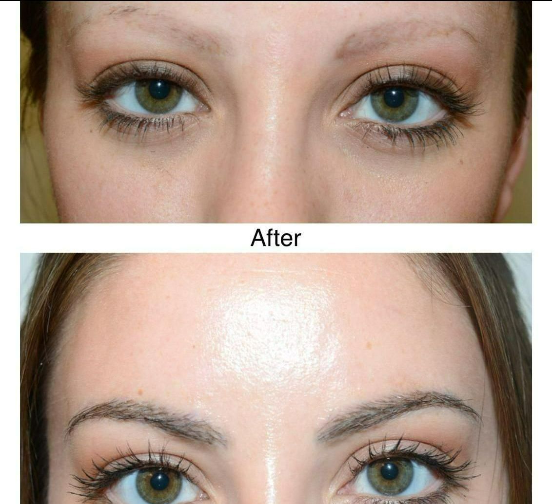 A female before and after undergoing a FUE eyebrow hair transplant